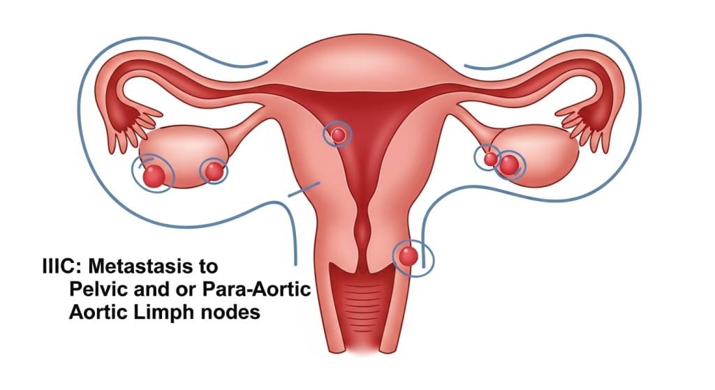 What Is Endometrial Cancer Staging? – dr. lucas minig
