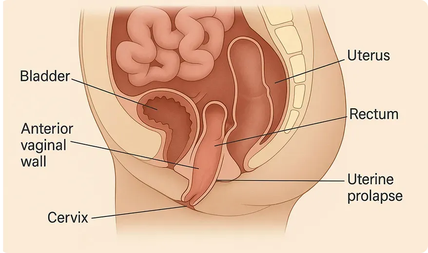 Make a medically accurate visualization for uterine fibroids