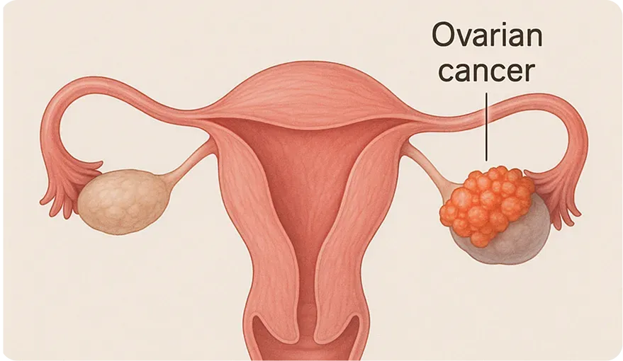 Make an image that is scientifically accurate that shows a normal ovarie, uterus and then a ovarie with a quist and also shows the vagina (medical visualization)